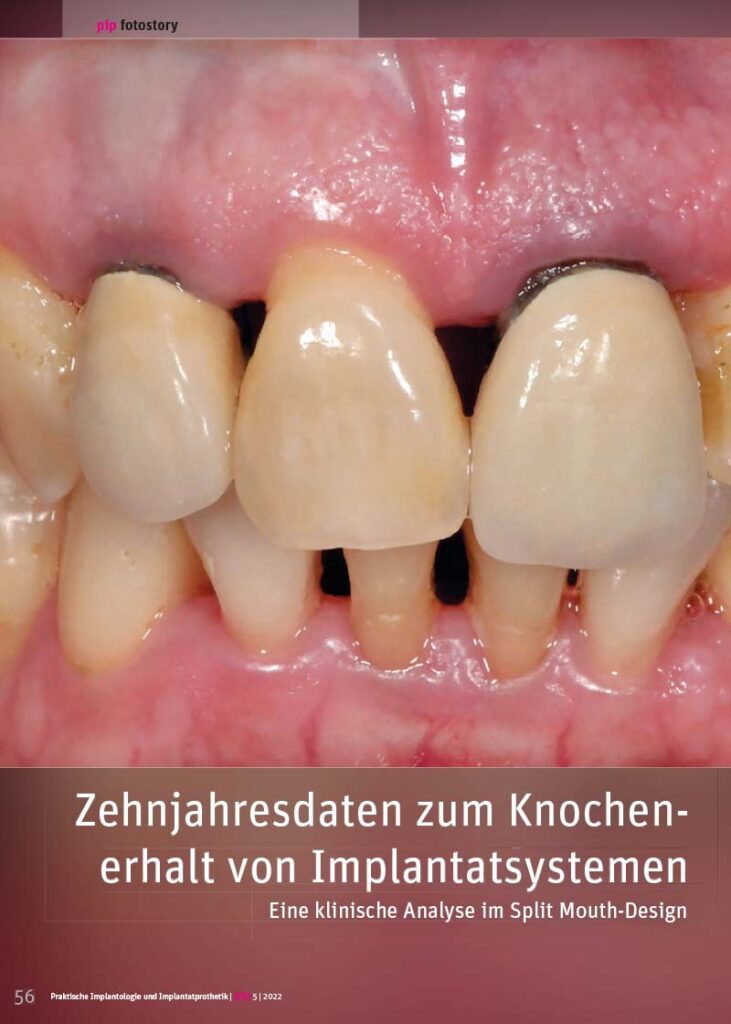 Zehnjahresdaten zum Knochenerhalt von Implantatsystemen