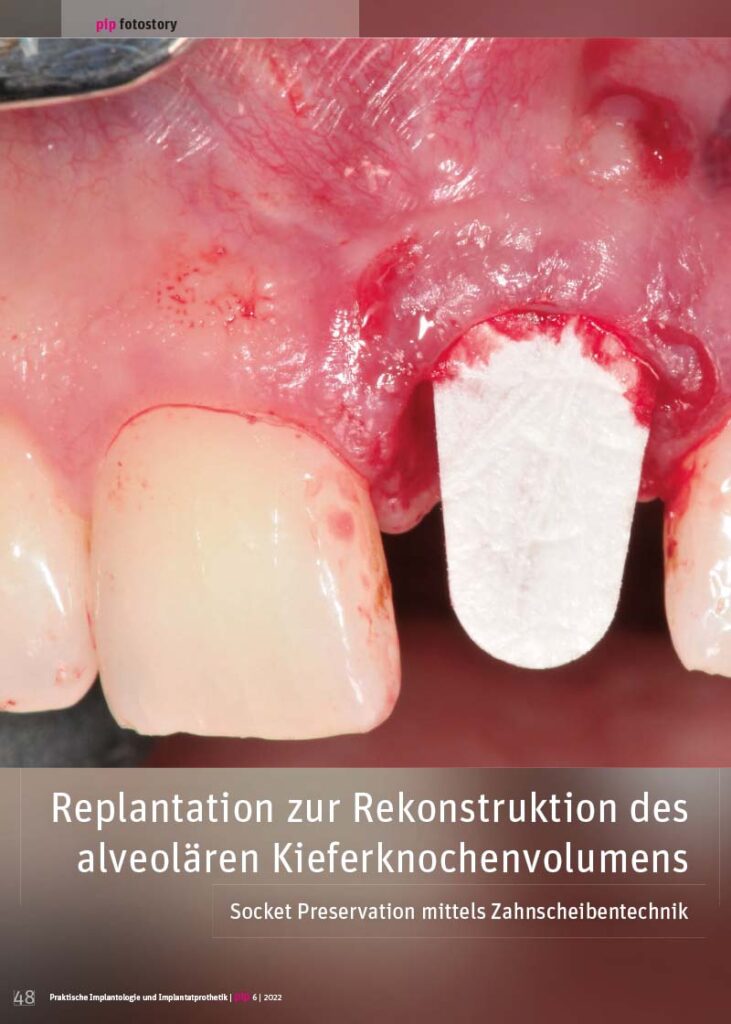 PIP Fotostory 6/2022: Replantation zur Rekonstruktion des alveolären Kieferknochenvolumens