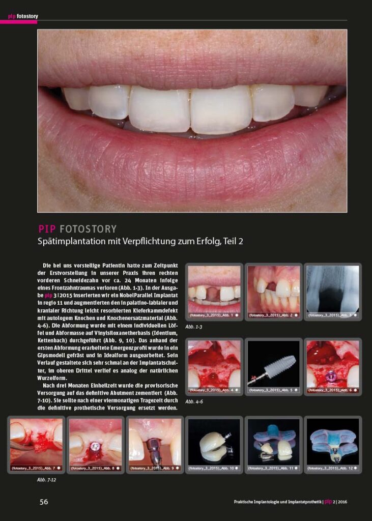 PIP Fotostory 2/2016: Spätimplantation mit Verpflichtung zum Erfolg – Teil 2