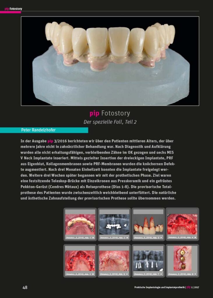 PIP Fotostory 1/2017: Optimale Versorgung im Oberkiefer – Der spezielle Fall – Teil 2