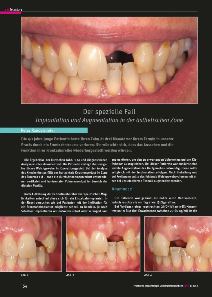 PIP Fotostory 1/2018: Implantation und Augmentation in der ästhetischen Zone