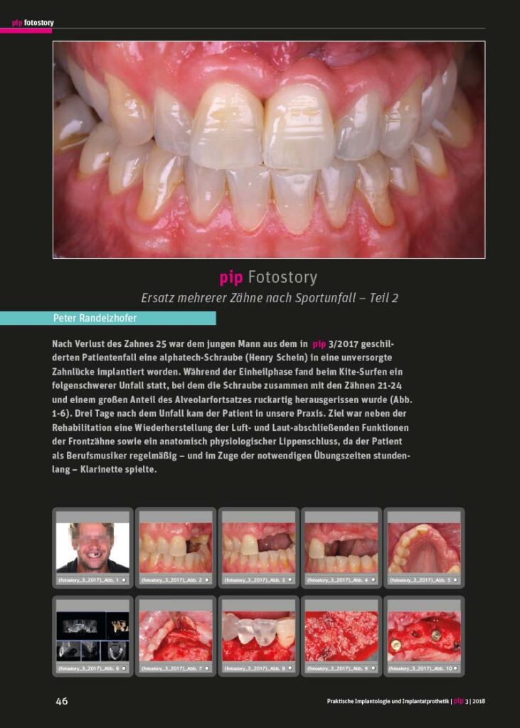 PIP Fotostory 3/2018: Ersatz mehrerer Zähne nach Sportunfall – Teil 2