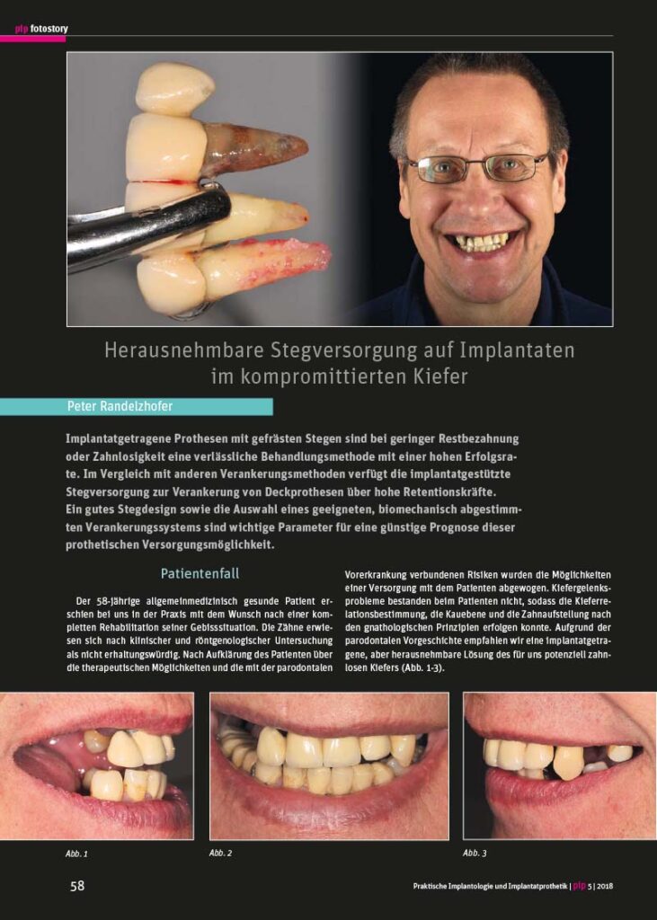 PIP Fotostory 5/2018: Herausnehmbare Stegversorgung auf Implantaten im kompromittierten Kiefer – Teil 1