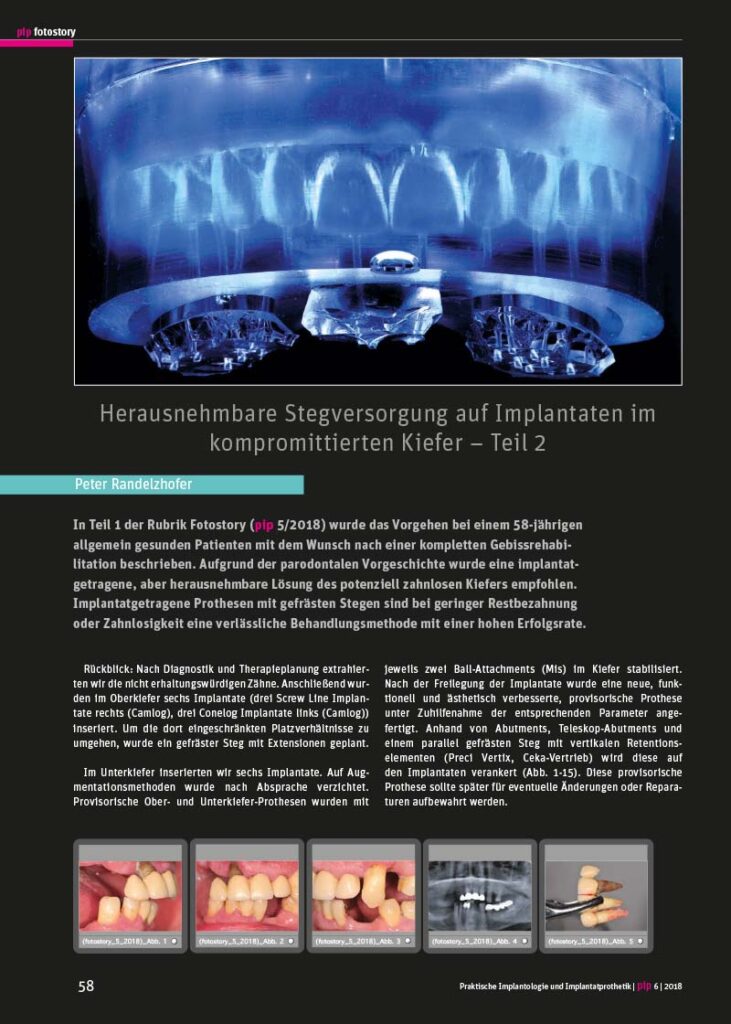 PIP Fotostory 6/2018: Herausnehmbare Stegversorgung auf Implantaten im kompromittierten Kiefer – Teil 2