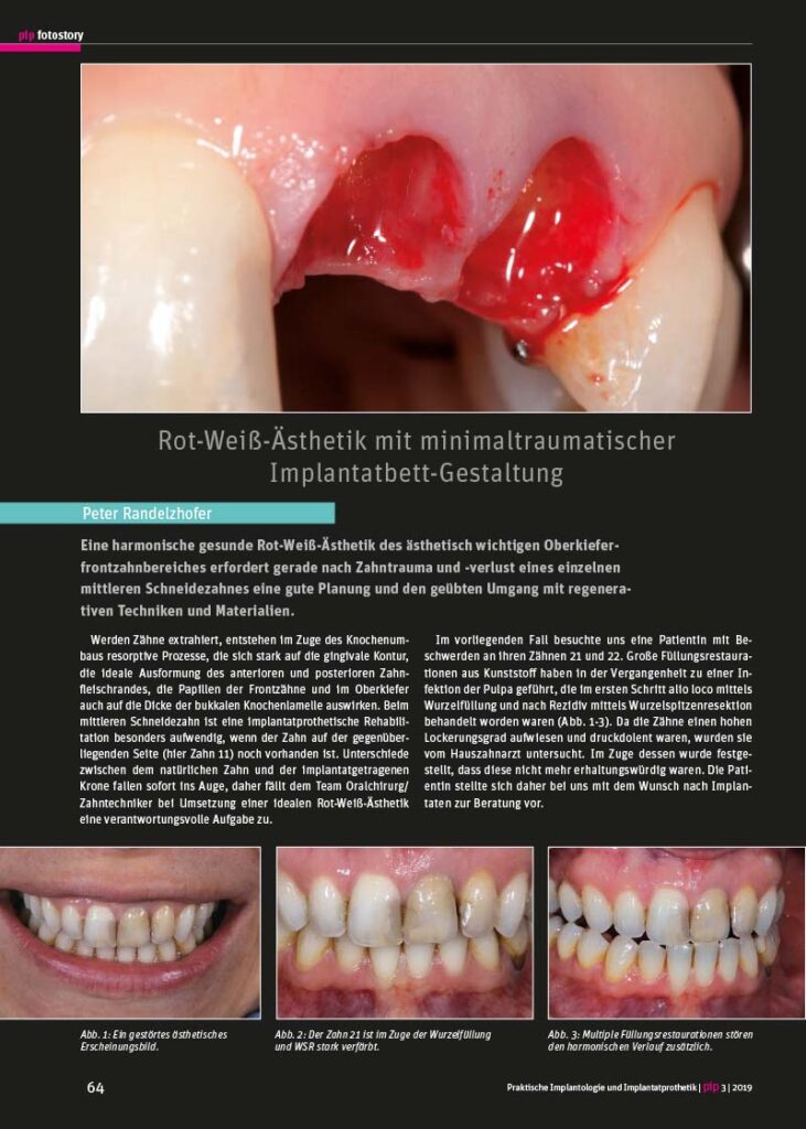 PIP Fotostory 3/2019: Rot-Weiß-Ästhetik mit minimaltraumatischer Implantatbett-Gestaltung