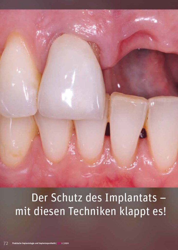 PIP Fotostory 1/2020: Der Schutz des Implantats – mit diesen Techniken klappt es!