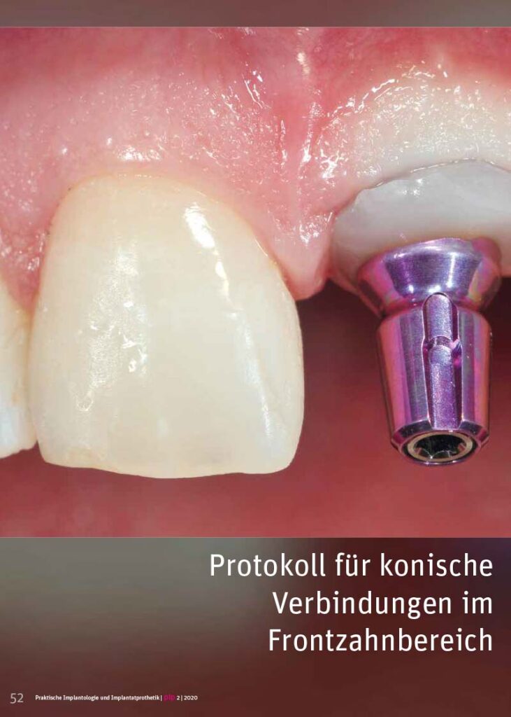 PIP Fotostory 2/2020: Protokoll für konische Verbindungen im Frontzahnbereich