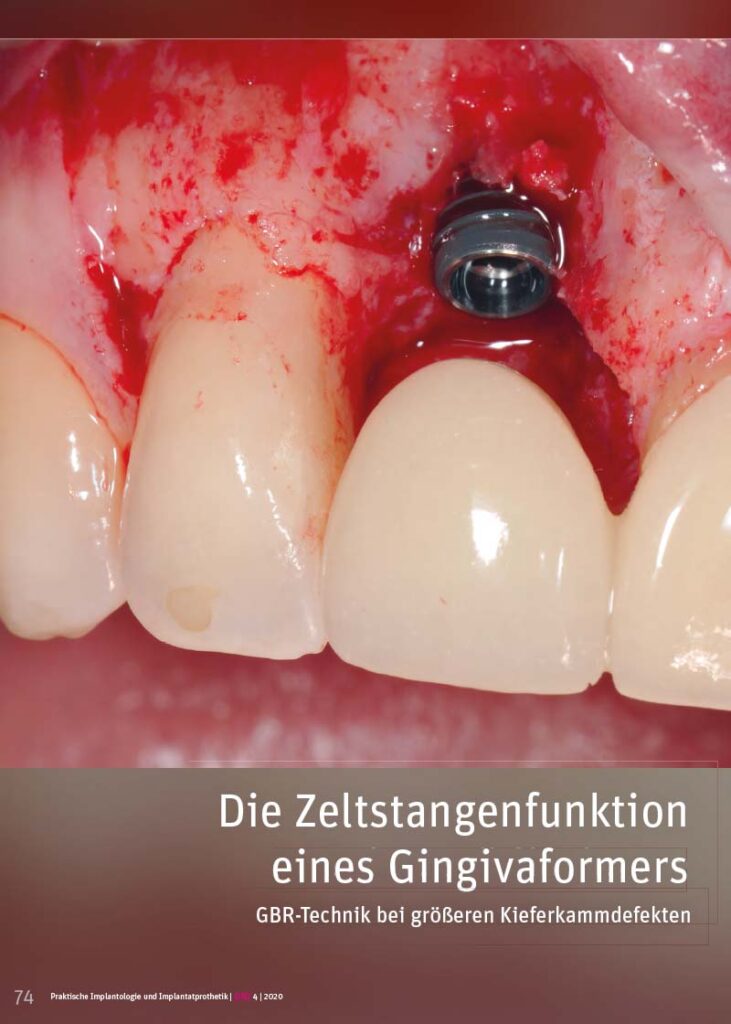 PIP Fotostory 4/2020: Die Zeltstangenfunktion eines Gingivaformers