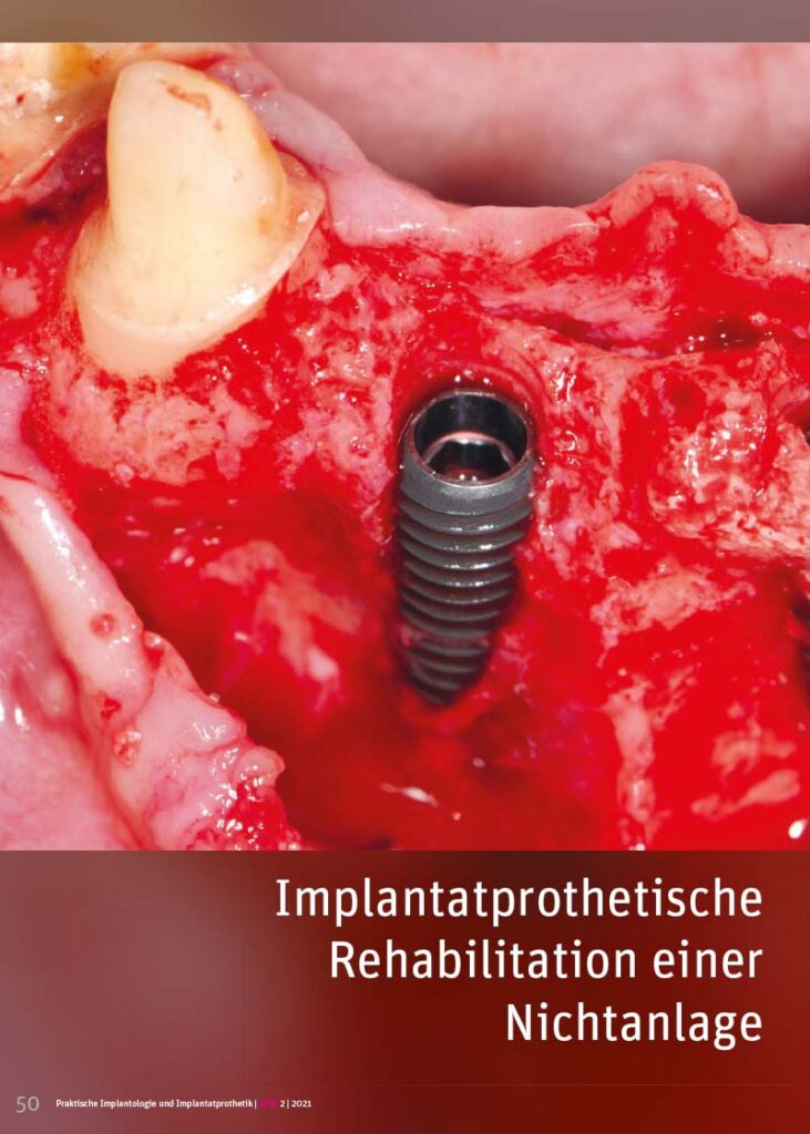 PIP Fotostory 2/2021: Implantatprothetische Rehabilitation einer Nichtanlage