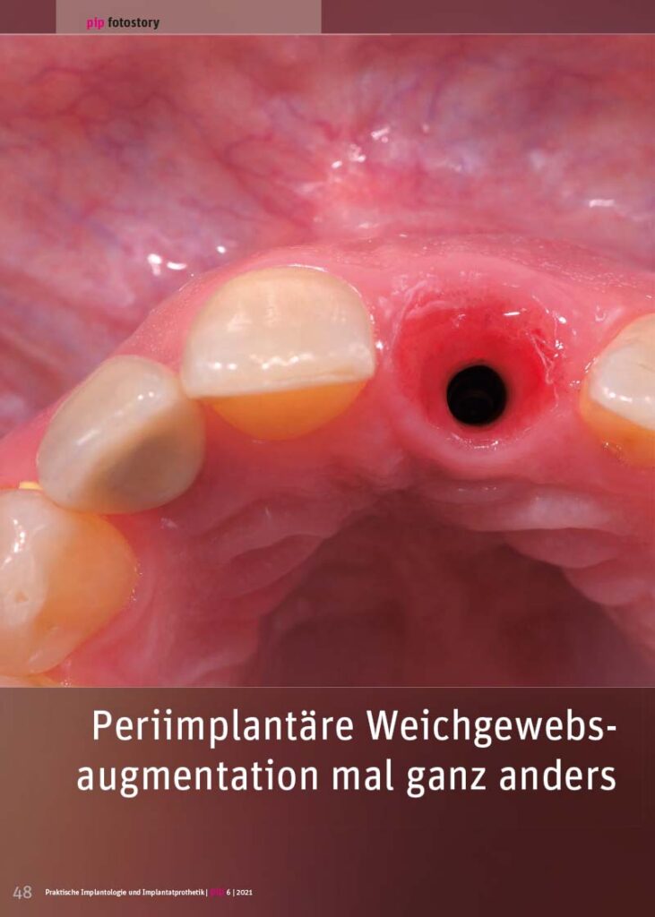 PIP Fotostory 6/2021: Periimplantäre Weichgewebsaugmentation mal ganz anders