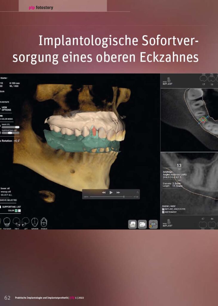 PIP Fotostory 1/2022: Implantologische Sofortversorgung eines oberen Eckzahnes