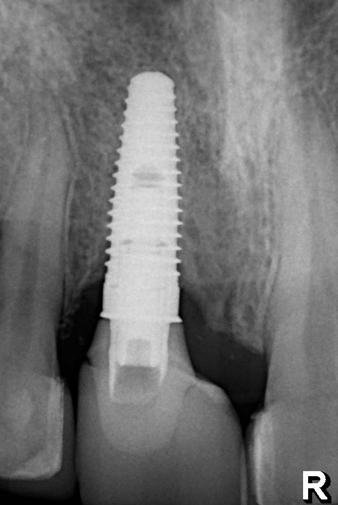 Knochenverlust am Implantat mit Entzündung