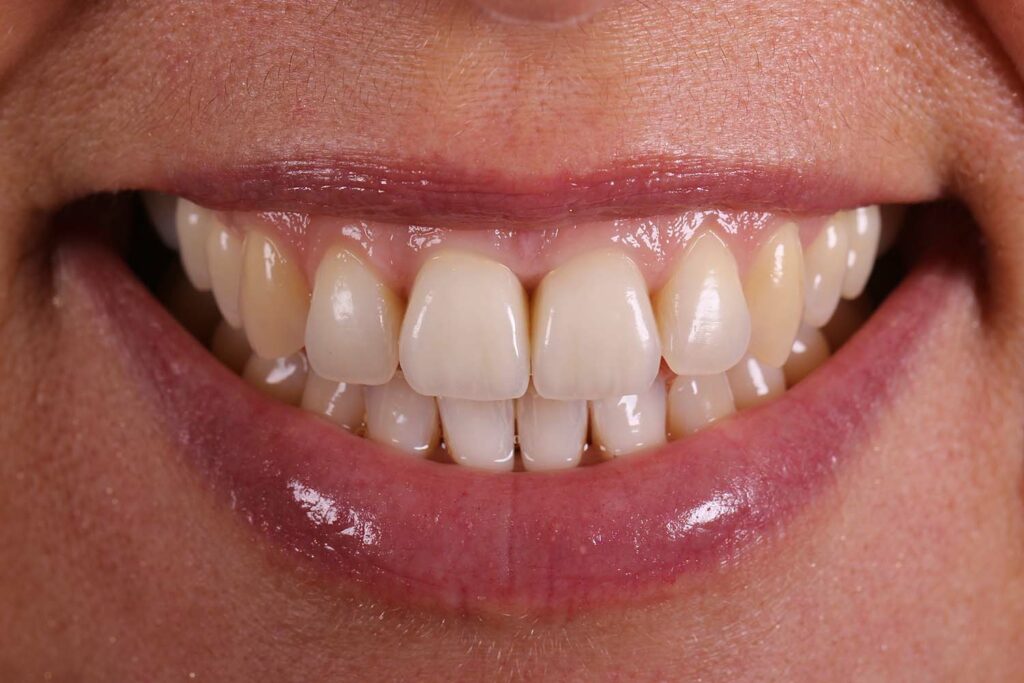 Gummysmile beide Implantatkronen aus Vollkeramik verschraubt