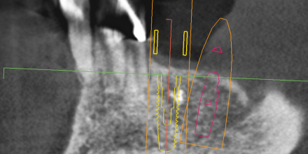 Implantat Setzen 1