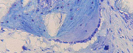 Bone grafting