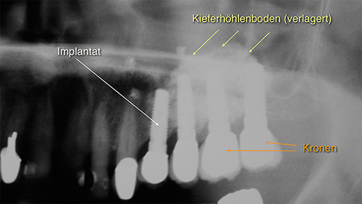 Sinuslift OP Patientenfall 1